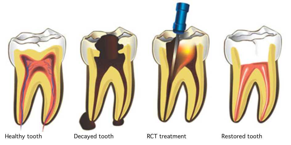Root canal