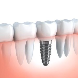 https://old.dentallifevalkenburg.nl/wp-content/uploads/2023/11/Implant-300x300.jpg