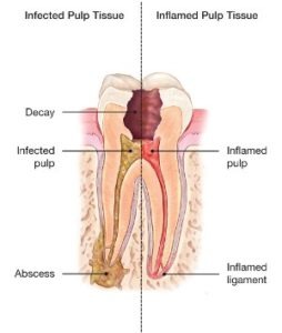 Root Caanal 3