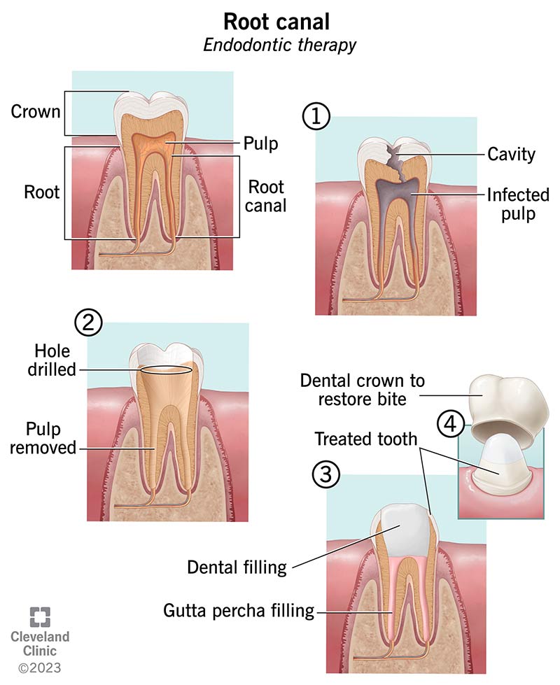 root-canal