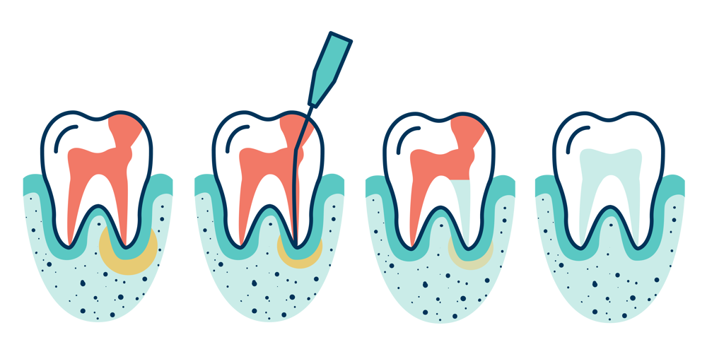 root-canals