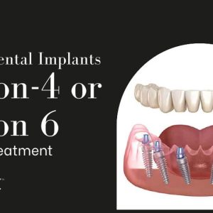 https://old.dentallifevalkenburg.nl/wp-content/uploads/2023/12/Which-is-Better-All-on-4-or-All-on-6-Dental-Implants-300x300.jpeg