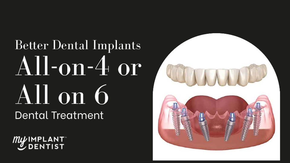 Which-is-Better-All-on-4-or-All-on-6-Dental-Implants