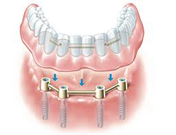 denture